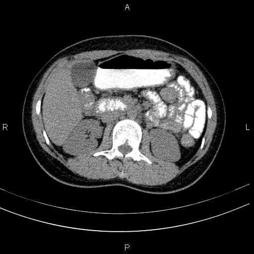File:Chronic pancreatitis (Radiopaedia 64576-73450 Axial non-contrast 63).jpg