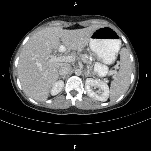 File:Chronic pancreatitis (Radiopaedia 64576-73450 C 35).jpg