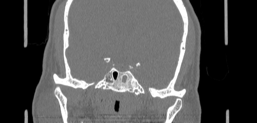 Chronic sphenoidal sinusitis (Radiopaedia 62030-70122 Coronal bone window 133).jpg