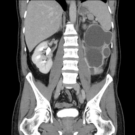File:Chronic ureteropelvic junction obstruction (Radiopaedia 78365-90996 B 60).jpg