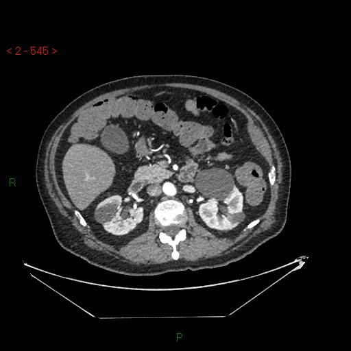 Circumaortic left renal vein and doubled left renal arteries (Radiopaedia 52268-58158 A 81).jpg