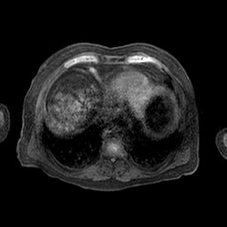 Cirrhosis and hepatocellular carcinoma in the setting of hemochromatosis (Radiopaedia 75394-86594 Axial T1 C+ fat sat 72).jpg