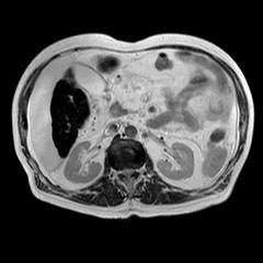 File:Cirrhosis and hepatocellular carcinoma in the setting of hemochromatosis (Radiopaedia 75394-86594 Axial T2 9).jpg