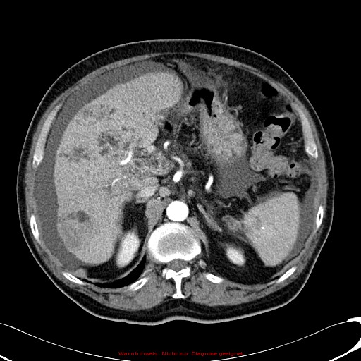 File:Cirrhosis and hepatocellular carcinoma in the setting of hemochromatosis (Radiopaedia 75394-86595 A 30).jpg