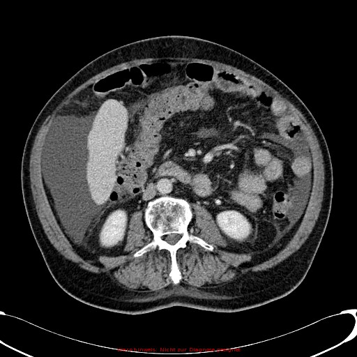 Cirrhosis and hepatocellular carcinoma in the setting of hemochromatosis (Radiopaedia 75394-86595 B 47).jpg