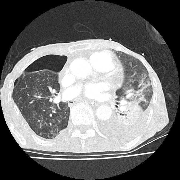 Clagett thoracotomy with bronchopleural fistula (Radiopaedia 29192-29587 Axial lung window 27).jpg