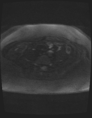 Class II Mullerian duct anomaly- unicornuate uterus with rudimentary horn and non-communicating cavity (Radiopaedia 39441-41755 Axial DWI 65).jpg