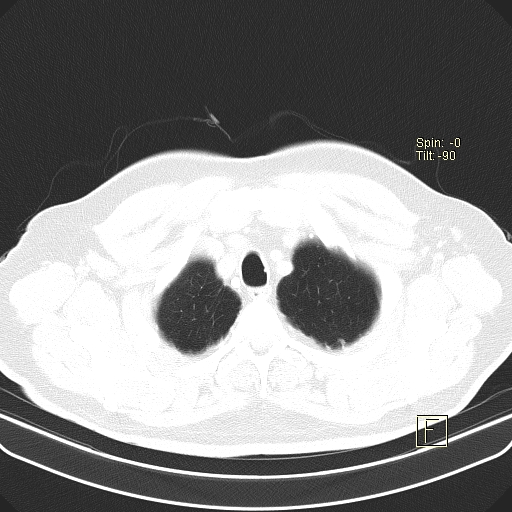Classic complicated silicosis (Radiopaedia 49720-54961 Axial lung window 4).jpg