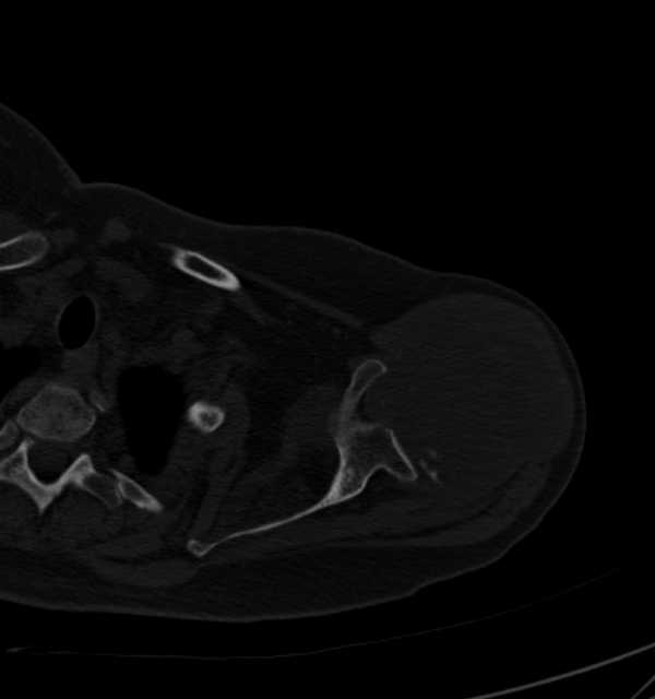Clear cell chondrosarcoma - humerus (Radiopaedia 63104-71612 Axial bone window 29).jpg