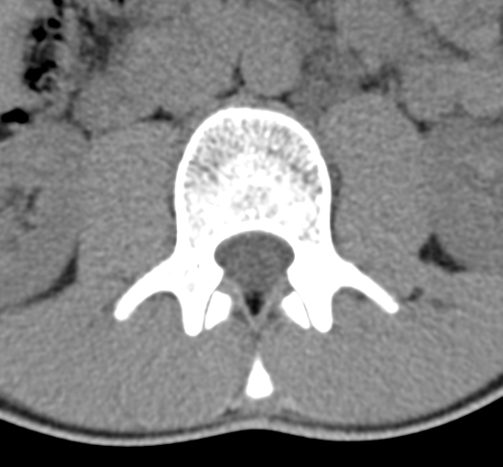 Clear cell meningoma - lumbar spine (Radiopaedia 60116-67691 Axial non-contrast 25).png