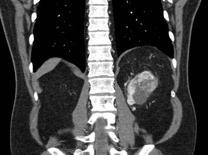 File:Clear cell renal cell carcinoma (Radiopaedia 61449-69393 C 40).jpg