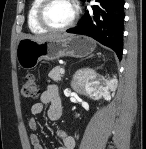 File:Clear cell renal cell carcinoma (Radiopaedia 61449-69393 D 36).jpg