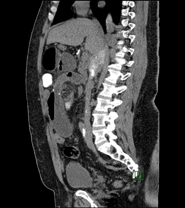 Closed-loop small bowel obstruction-internal hernia (Radiopaedia 78439-91096 C 83).jpg
