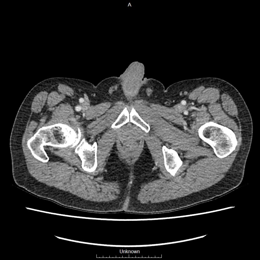 Closed loop bowel obstruction and ischemia (Radiopaedia 86959-103180 A 93).jpg