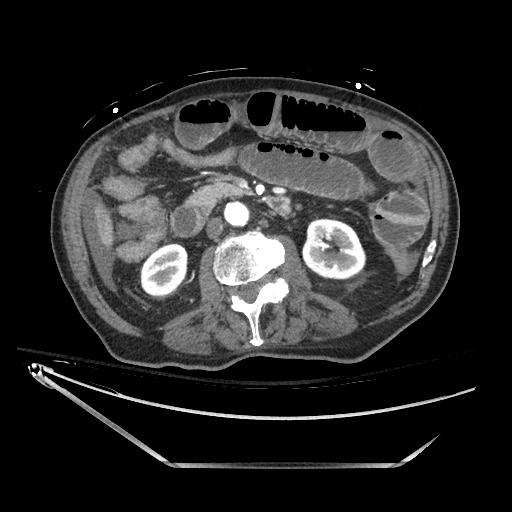 Closed loop obstruction due to adhesive band, resulting in small bowel ischemia and resection (Radiopaedia 83835-99023 B 68).jpg