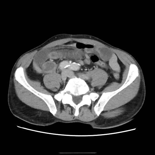 Closed loop small bowel obstruction (Radiopaedia 59227-66554 A 59).jpg