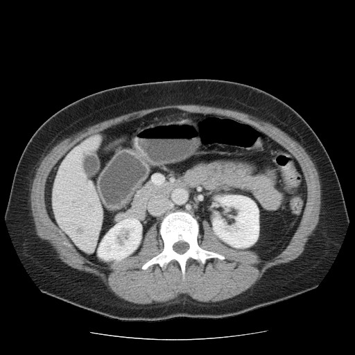 File:Closed loop small bowel obstruction (Radiopaedia 65403-74451 A 34).jpg