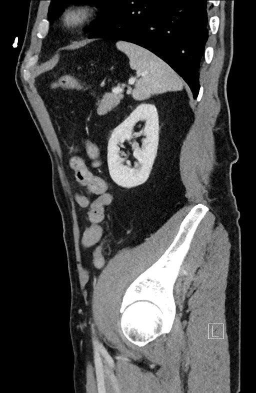Closed loop small bowel obstruction - internal hernia (Radiopaedia 57806-64778 C 30).jpg