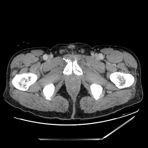 File:Closed loop small bowel obstruction - omental adhesion causing "internal hernia" (Radiopaedia 85129-100682 A 178).jpg