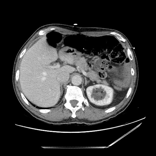 Closed loop small bowel obstruction - omental adhesion causing "internal hernia" (Radiopaedia 85129-100682 A 37).jpg