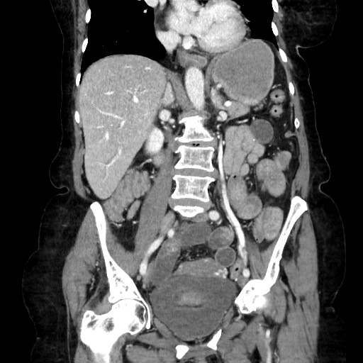 File:Closed loop small bowel obstruction due to adhesive band, with intramural hemorrhage and ischemia (Radiopaedia 83831-99017 C 66).jpg