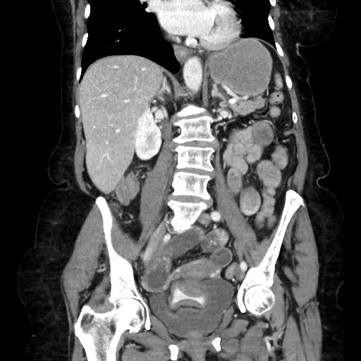 File:Closed loop small bowel obstruction due to adhesive band, with intramural hemorrhage and ischemia (Radiopaedia 83831-99017 C 70).jpg