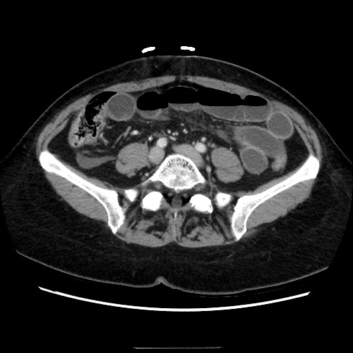Closed loop small bowel obstruction due to adhesive bands - early and late images (Radiopaedia 83830-99015 A 111).jpg