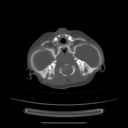 Cloverleaf skull (Radiopaedia 91901-109710 Axial bone window 44).jpg