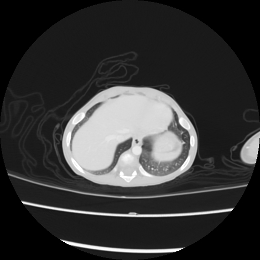 Coarctation of the aorta and patent ductus arteriosus (Radiopaedia 68033-77499 Axial lung window 54).jpg