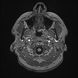 Cochlear incomplete partition type III associated with hypothalamic hamartoma (Radiopaedia 88756-105498 Axial T1 27).jpg