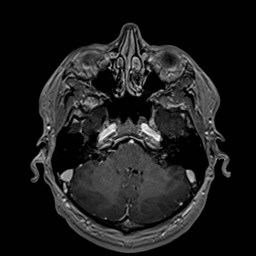 File:Cochlear incomplete partition type III associated with hypothalamic hamartoma (Radiopaedia 88756-105498 Axial T1 C+ 58).jpg