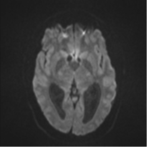 Colloid cyst (Radiopaedia 53164-59125 Axial DWI 40).png