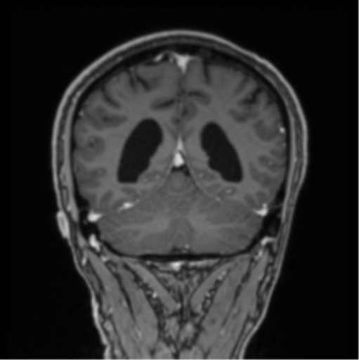 File:Colloid cyst of the third ventricle (Radiopaedia 86571-102662 Coronal T1 C+ 28).png