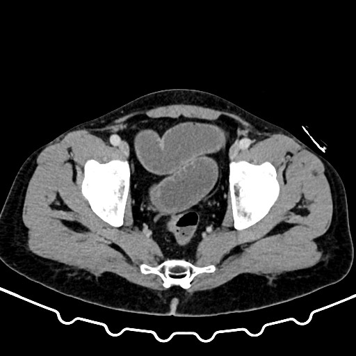 Colocolic intussusception due to large lipoma (Radiopaedia 68773-78482 A 172).jpg