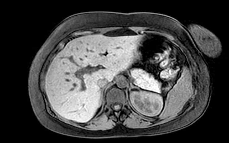File:Colon adenocarcinoma with Krukenberg tumors, advanced pregnancy (Radiopaedia 67279-76645 A 64).jpg