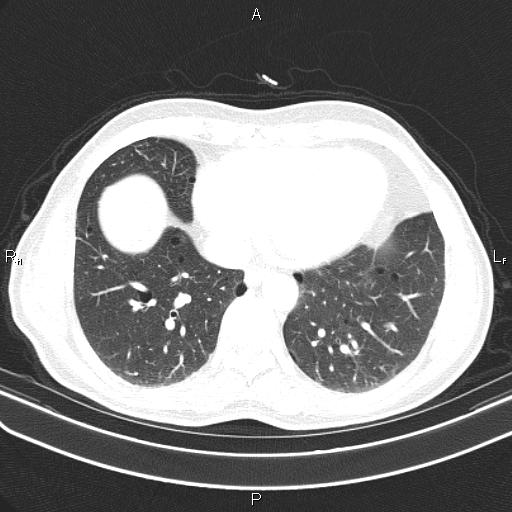 File:Colon cancer (Radiopaedia 85663-101443 Axial lung window 46).jpg