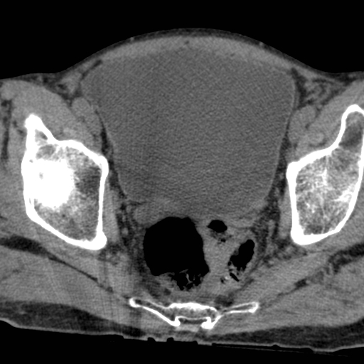 Colon cancer with calcified liver metastasis (Radiopaedia 74423-85309 Axial non-contrast 104).jpg