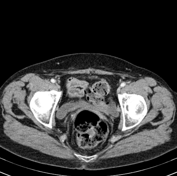 Colon carcinoma with hepatic metastases (Radiopaedia 29477-29961 A 105).jpg