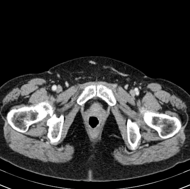Colon carcinoma with hepatic metastases (Radiopaedia 29477-29961 A 117).jpg