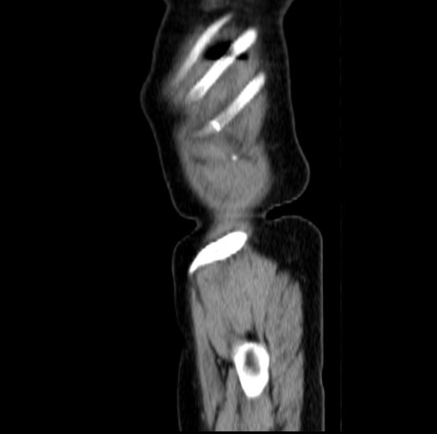 Colon carcinoma with hepatic metastases (Radiopaedia 29477-29961 C 55).jpg