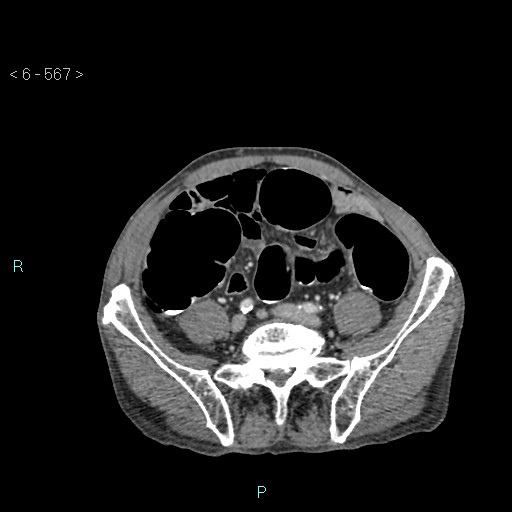 File:Colonic cancer (ultrasound and TC imaging) (Radiopaedia 50346-55713 A 90).jpg