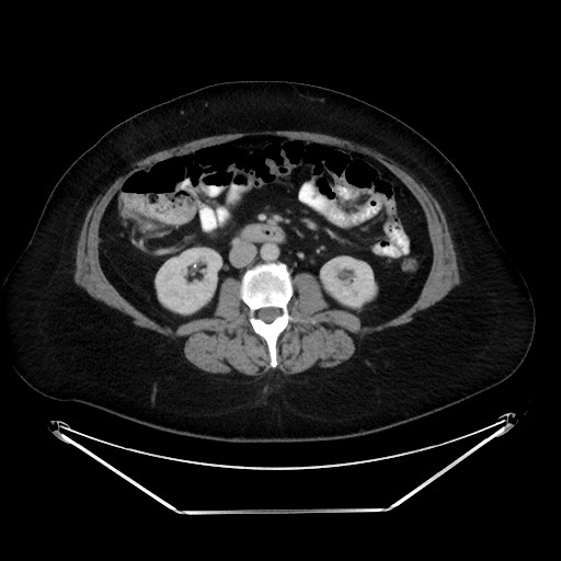 File:Colonic intussusception due to adenocarcinoma (Radiopaedia 86828-102987 A 74).jpg