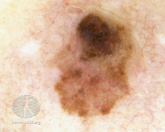 File:Dermoscopy of nodular melanoma arising within a superficial spreading melanoma (DermNet NZ nodular-melanoma-14).jpg