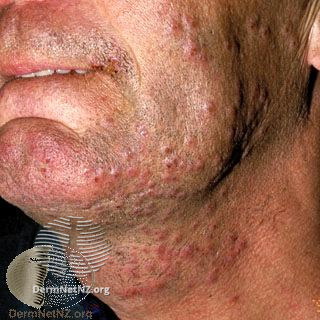 File:Herpes simplex (DermNet NZ 2858).jpg