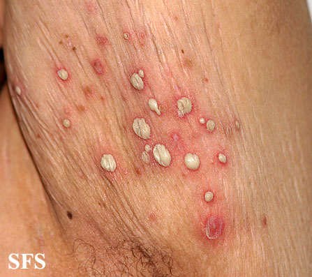 File:Impetigo (Dermatology Atlas 40).jpg
