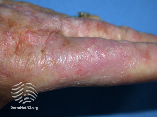 Intraepidermal carcinoma (DermNet NZ lesions-scc-in-situ-2972).jpg
