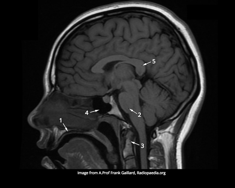 File:MRI Head (Quiz) (Radiopaedia 60281).jpg