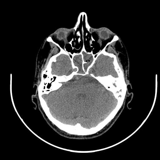 File:Nasopharyngeal carcinoma - infiltrating the clivus (Radiopaedia 62583-70875 Axial non-contrast 7).jpg