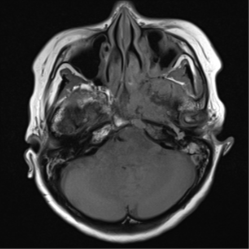 File:Nasopharyngeal carcinoma with cerebral abscess (Radiopaedia 43018-46273 Axial T1 15).png