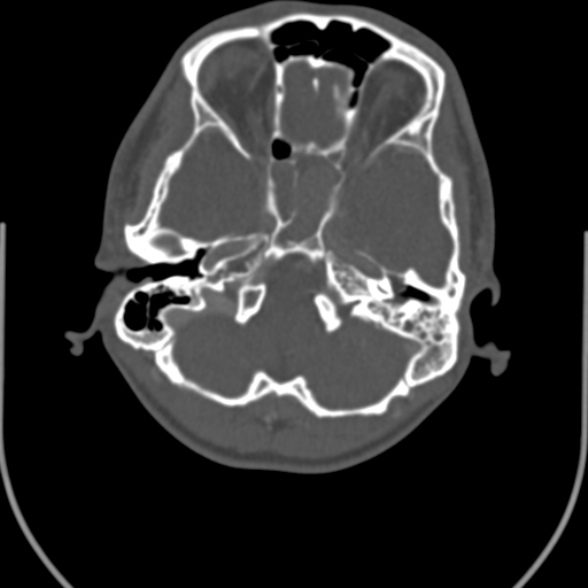 File:Nasopharyngeal carcinoma with skull base invasion (Radiopaedia 53415-59705 Axial bone window 14).jpg